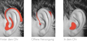 Visualisierung Hörgeräte Versorgung am Ohr